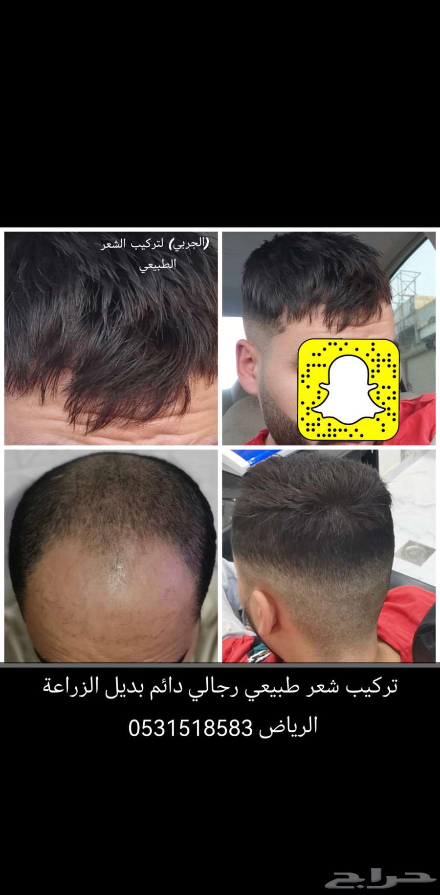 Permanent men's wig installation63142829092739114