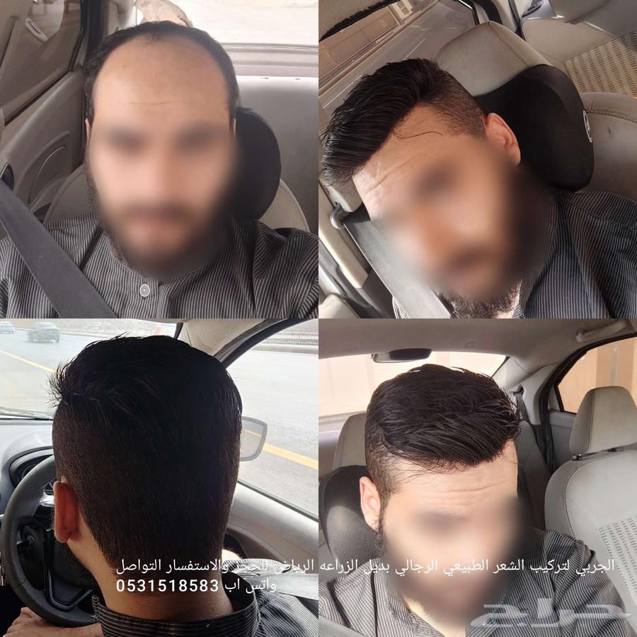 Permanent hair installation in Riyadh63141392553090111
