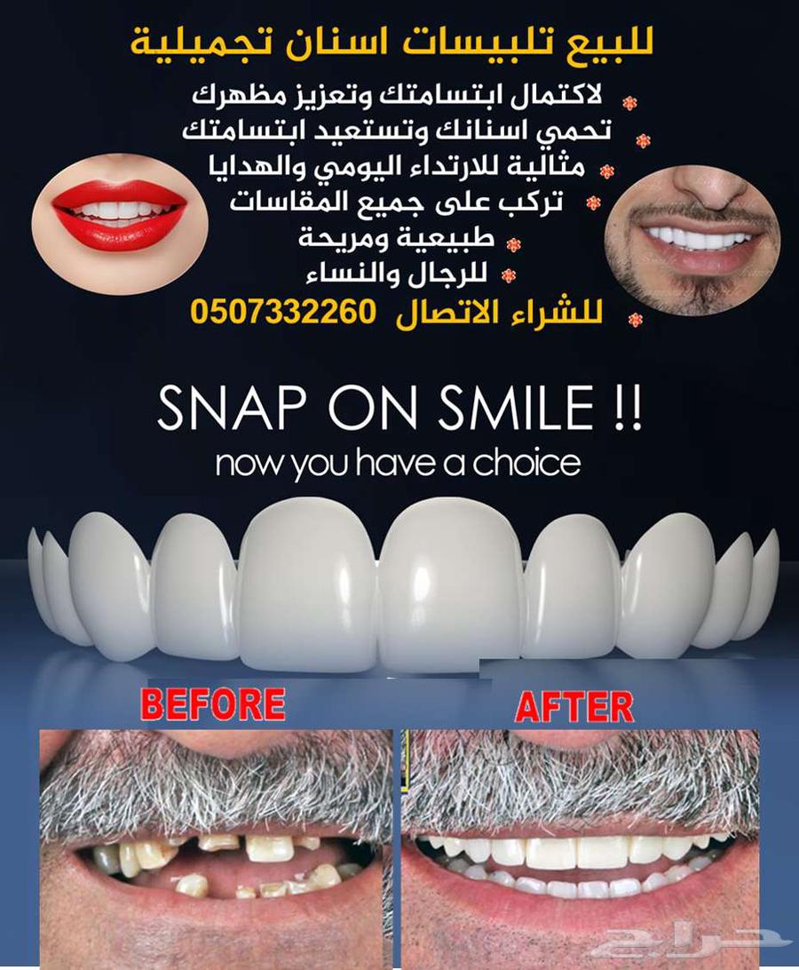 للبيع تلبيسات اسنان تجميلية64589557353985110