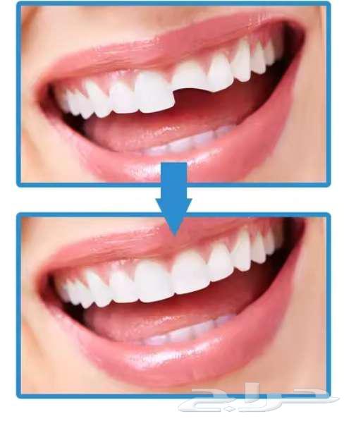 تعويض سنك المفقود والمكسور64583114216706112