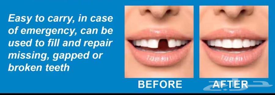 تعويض سنك المفقود والمكسور64583114216706111